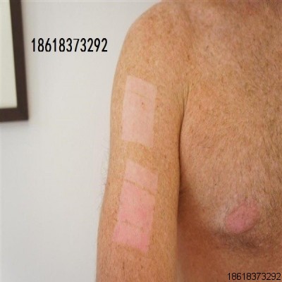 強脈沖光真OPT的辨別，附大量實例對比